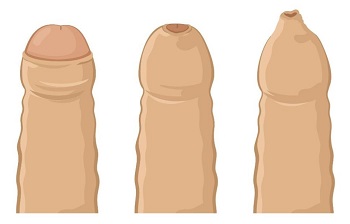 包茎（ほうけい）について